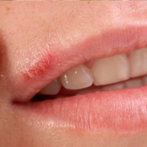 Close-up of male cold sore with homeopathic medicines on table